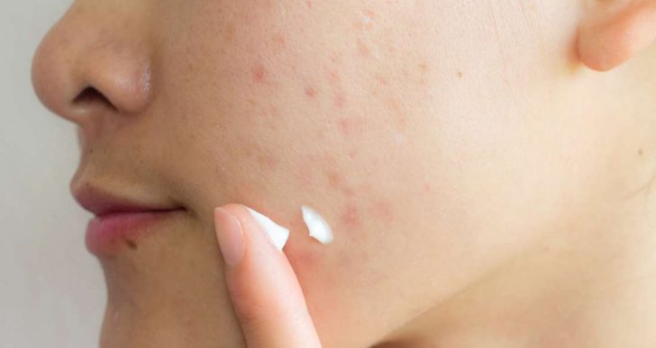 Cómo eliminar las cicatrices causadas por el acné